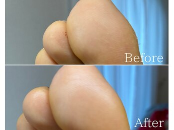 カシェット 広島店(Cachette)/50代女性☆足裏角質ケア60分