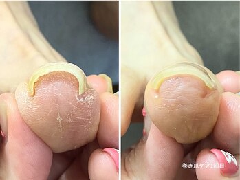 コバコ(kobaco)/巻き爪ケア　初回