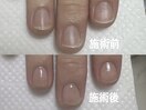 自爪育成で爪の形を整える！