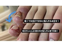 巻き爪じゅん 千葉駅前店/激痛の陥入爪も1回で改善へ！