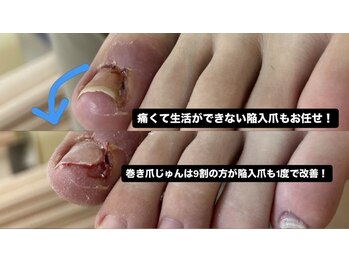 巻き爪じゅん 千葉駅前店/激痛の陥入爪も1回で改善へ！