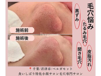 ベルガモットの写真/皮脂分泌倍増で毛穴汚れが気になる方へ!開き毛穴や黒ずみ毛穴を優しく整える特別なエステ◎