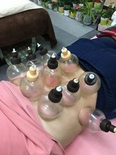 ベストヘルス治療院/吸角法　カッピング