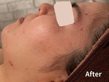 ダイヤモンド リーエンダ(Diamond leende)/クレイハーブピーリング