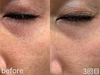 ハレオラ(HaleOla)/30代☆白いプツプツが消えた!!