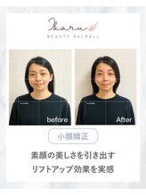 イカル 池袋(ikaru)/小顔矯正 before after 