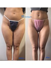 アンジェラ(angera)/ハイパーナイフビフォーアフター