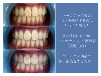 ホワイトニングカフェ 平塚店(WhiteningCafe)/◎歯のホワイトニング施術写真◎