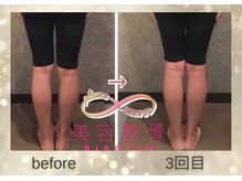 【施術3回目の変化：30代女性：O脚改善/骨盤矯正】