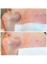 アトレ(Atre)/繰り返す肌荒れ悩みありますか？