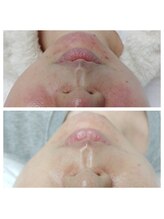 アイヴィー(EYEVY)/ララピール症例写真