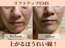 ラーナ(Lana)/リフトアップEMS　BIFORE→AFTER