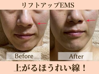 ラーナ(Lana)/リフトアップEMS　BIFORE→AFTER