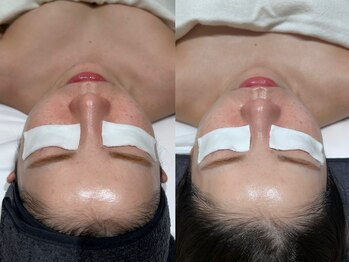 フロムミー 銀座本店(FROM ME)/3Xダーマジオ