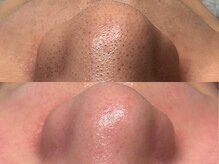 スリーナイン ビュウ(3Nine BEAU)/2回目before/after