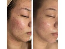 アドビューティ(Add Beauty)/≪プラズマフェイシャル≫