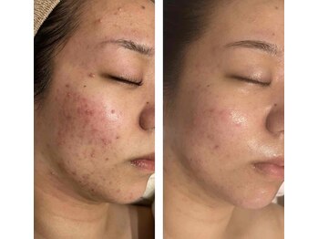 アドビューティ(Add Beauty)/≪プラズマフェイシャル≫