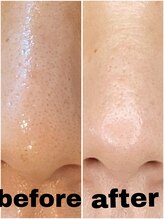 ブルーム(BLOOM)/REVI陶肌トリートメント