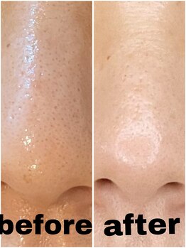 ブルーム(BLOOM)/REVI陶肌トリートメント