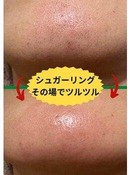 ディスイズミー シュガーリング(This is me Sugaring)/【シュガー】あご下のガサガサ