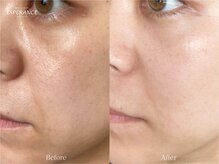 エステティックサロン エスぺランス(ESPERANCE)/お肌のトーンアップ