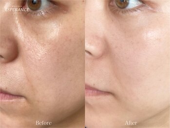 エステティックサロン エスぺランス(ESPERANCE)/お肌のトーンアップ