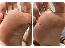 ロンディネ(Rondine)/足裏角質ケア