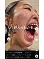 ハーバリー ハーブピーリング 大阪梅田店(HERBERRYハーブピーリング)&nbsp;剥離ありハーブピーリングなら、どんな悩みも解決！！