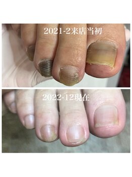 プラスキュア 用賀店(+CURE)/肥厚爪 変形爪 副爪 60分6600~