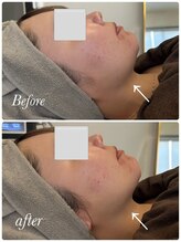 スリビア(SLIVIA)/二重顎撃退！ビフォーアフター