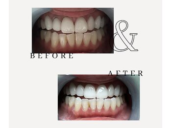 とぅるりん 肌質改善/お試しあれ★一回で驚きの白さ！