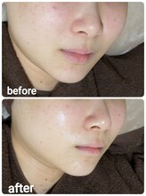 ウララ(ulala)/ララピール1回目