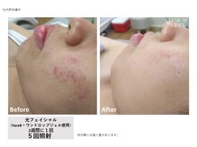 目が美きゅっと/ニキビケア・韓国陶器肌コース