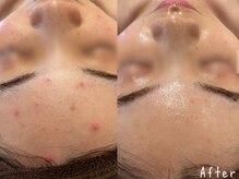 エヌエースキン 武蔵小杉店(Naskin)/ニキビケアにはハーブピーリング