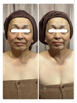 エミニー バイ エルズ(Eminy by L★s)/60代 小顔コルギ 1 回