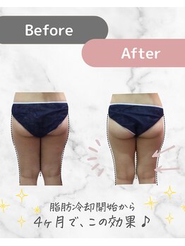 ミネット(minette)/脂肪冷却*before→after