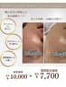 《初回限定》頬の毛穴/シミを集中ケア　50分