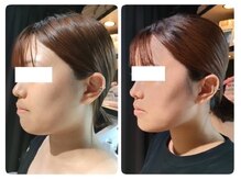 ファームディ(Pharm.D)/たるみ