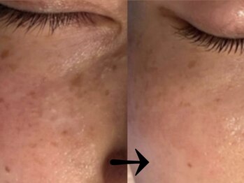 サロン ドロップ 上小田井(Salon drop)/「シミ改善」途中経過