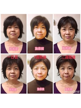 わたしの/小顔矯正