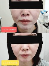 縁(en)/レモンボトル一回の変化