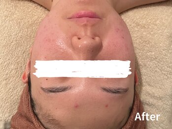 ダイヤモンド リーエンダ(Diamond leende)/クレイハーブピーリング