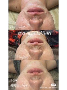 スパアルデバラン(spa.ALDEBARAN)/【afterのアップデート】