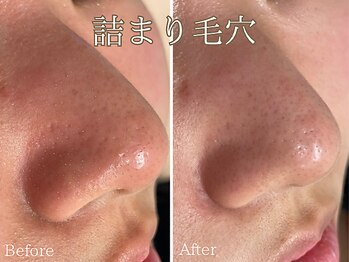 シエナ(ciena)/水素水毛穴洗浄症例写真♪