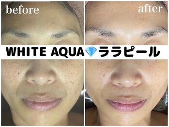 ホワイトアクア 柏店(WHITE AQUA)/ララピール/美白/くすみ