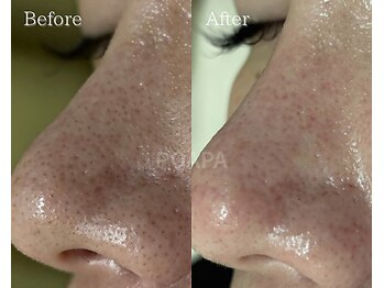 ポアラ(POARA)/毛穴/ワックス脱毛