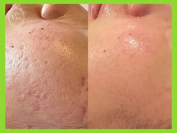 ハーブピーリング 名古屋/肌質改善にはハーブピーリング♪