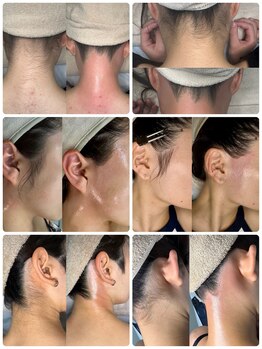 エステリア 蒲田の写真/もっと早く知りたかったとのお声多数！ダブル脱毛で即ツル＋減りの速さ◎