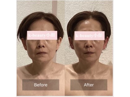 ケービューティー 小顔(K-beauty)の写真
