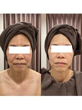 リライズ 磐田(Rerise)/オーダー小顔エステ